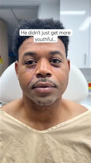 Insane MALE Facelift Transformation 🤯 He Looks Younger AND More Handsome