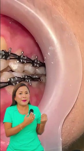 🦷 Hoy la Dra. Tania nos explica cómo se realiza una instalación de brackets, paso a paso, para alin