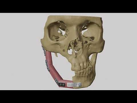 Mandibular Reconstruction using Fibula Graft