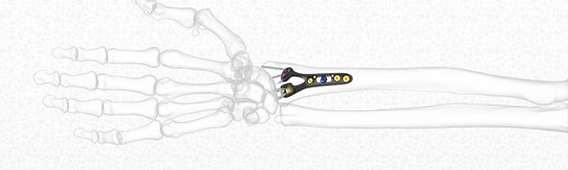GEMINUS® Distal Radius Plate - Skeletal Dynamics