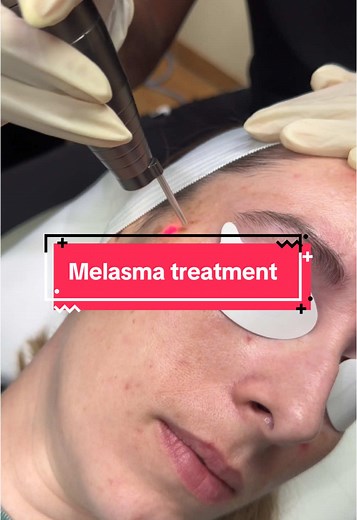 Melasma can be tough, but you don’t have to deal with it alone. Our Hollywood Spectra laser safely targets excess pigmentation breaking it down without harming your skin. With a series of treatments, you’ll see a brighter, more even complexion. Stay tuned for her results! #phoenix #fy #fypp #arizona #skincare #skin #medspalife #booknow #foryoupagе #fypシ #chandler #lutronic #foryoupageofficiall #esthetician #melasma #melasmatreatment #pigmentation #pigment #laser #lasertreatments #staytuned