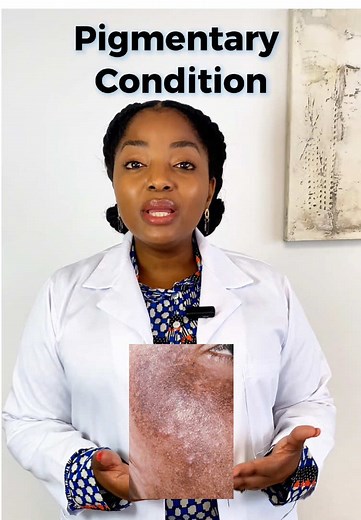 What’s Melasma? Let’s break it down! Dark patches caused by sun, hormones, or genetics. It’s treatable—so don’t stress! 💡 Tip: Wear SPF every day! 👩‍⚕️ See a derm for personalized care. #Melasma #SkinCareTips #DermatologyExplained #drzenamalinga