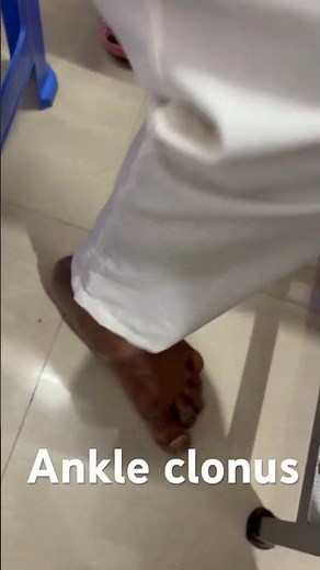 Ankle clonus. To and fro movement of ankle in a patient of post stroke spasticity.