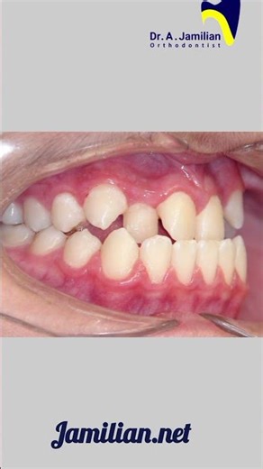 ixing a Narrow Upper Jaw Without Surgery | Modern Orthodontic Treatment Explained #orthodontics