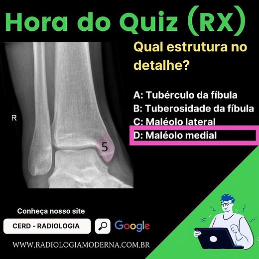 Radiografia do tornozelo: Maléolo medial