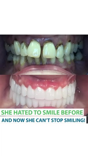 Transform Your Smile in Just 24 Hours at The Smile Mission