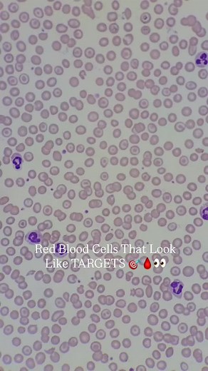 Target cells are erythrocytes (red blood cells) with a characteristic bullseye appearance, This morphology results from an increased surface area-to-volume ratio, often due to excess membrane or decreased intracellular hemoglobin. Commonly seen in: • Thalassemia • Liver disease • Iron deficiency anemia • Post-splenectomy states Their presence can indicate impaired hemoglobin synthesis or altered red cell membrane integrity. Recognizing and reporting them under the microscope is key to guiding fu