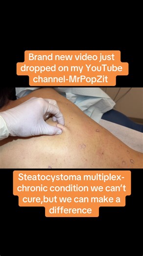 Steatocystoma multiplex incision and drainage with sac removal. Video just dropped on my youtube channel - MrPopZit, come check it out! #medicaleducation #dermatology #skincare #mrpopzit #mrpopzitlive #youtube #youtuber #physicianassociate #skin #popaholic #extractions #steatocystoma