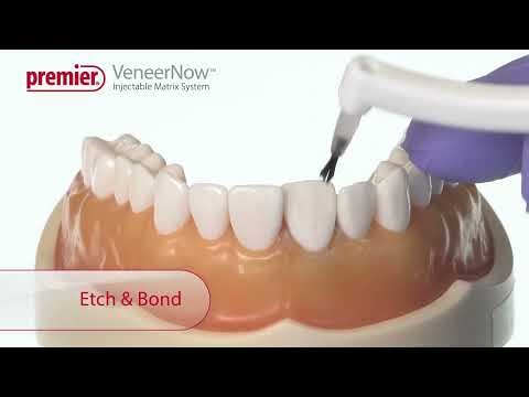 VeneerNow™ Injectable Matrix System - For Misaligned Teeth