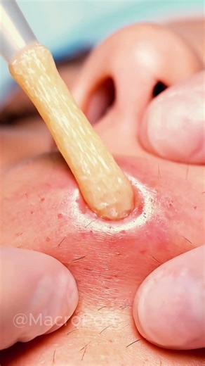 One Slow Pull — A Huge Sebum Plug Comes Out 😮‍💨