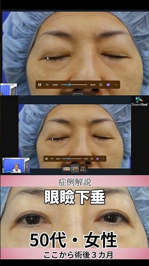 眼瞼下垂手術の症例解説