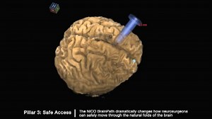 New tech allows for less invasive brain surgeries