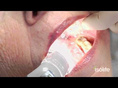 How to Select and Insert Isolite Mouthpieces