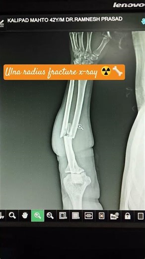ulna radius fracture x-ray #viralshorts#radiology ‪@YouTube‬