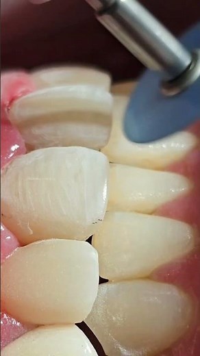 teeth polishing procedure |composite veneer restorations for anterior tooth |dental asmr