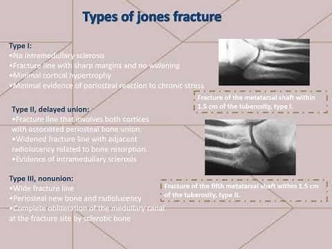 Jones fracture
