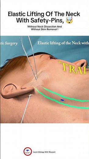 Elastic Lifting of the Neck with Safety-pins 🤯! Animated Video