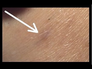 Electrolysis on Ingrown Hairs: Step by Step