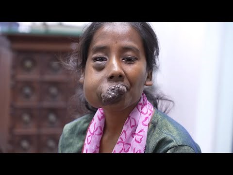 Unbelievable Face Tumor for a Young Girl