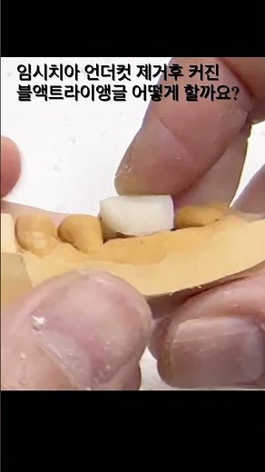 How do you explain the enlarged black triangle after the temporary tooth undercut was removed?