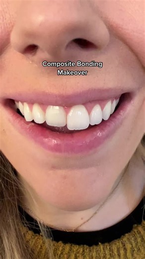 Composite Bonding Makeover