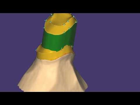 exocad 6547 Telescope in a minute 1