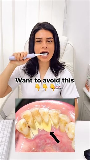 Dr.Shahrzad Kadkhodayan on Instagram: "Prevent calculus buildup behind lower teeth with one simple step #calculus #teethcare #oralcare #toothbrushtips #reelsinstagram #trendingreels"