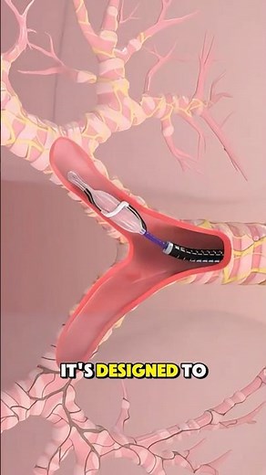 Surgery to Removing a Stomach Tumor – Symptoms #3danimation #symptoms #stomach #stomachcancer #pain