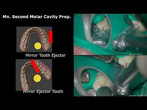 Right Mandibular Molar Cavity Preparation-Mirror and Suction Position