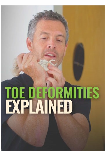 Understanding Toe Deformities: Causes and Solutions
