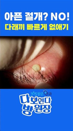 No Painful Incisions: Get Rid of Styes Quickly