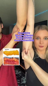 Normal fat vs Lipedema? Fibrosis and nodules vs none. Follow to learn more! #lipedema #lipedemafighter #lipedemaawareness #fat | Michelle - Lipedema Care
