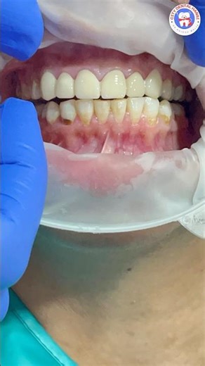 how zirconia crown can transform smile | smile |#drrajeshmalik |#cap #zirconiacrown #shorts #dental