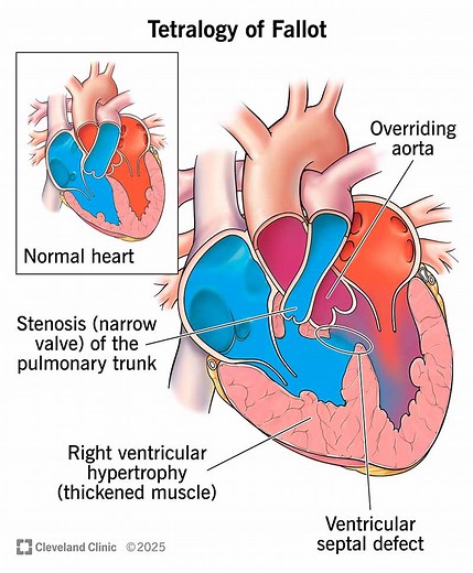 What Is Tetralogy of Fallot?