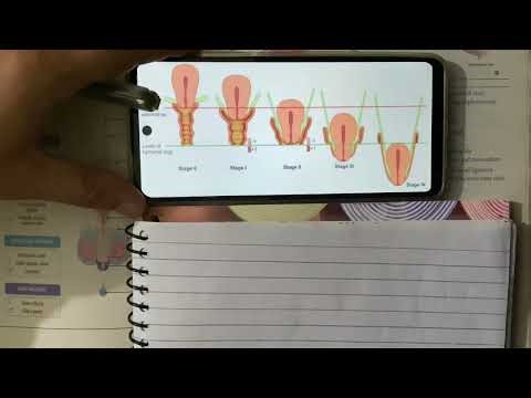 Uterine prolapse 2, pathophysiology, clinical features, diagnosis and treatment