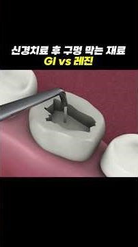 Choosing a Dental Material (Resin vs. GI)