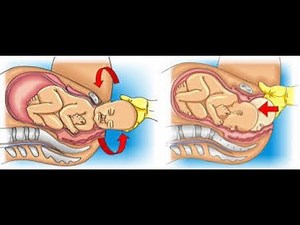 Zavanelli maneuver ; pushing baby’s head back into birth canal, emergency cesarean section
