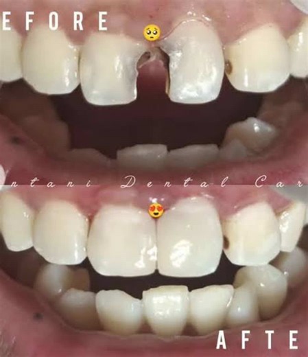 #gctoothmousse #pembersigigi #gigianak #pemutihgigi #kariesgigi