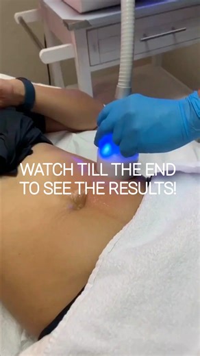 👋 Hey Staten Island Ladies! Unveil Your Best Self with our Cryo Special! 🌟 Ready to get rid of stubborn fat permanently? ✨ Introducing our Cryo Slimming Package for only $249! It includes Cryo Slimming session with EMSculpt Toning Session Styku 3D Body scan $100 Gift Card⭐️ Why you will love these 3 treatments? - Up to 1-3 inch loss from the first session itself - Permanent Fat Reduction - Non- Invasive - No Downtime, No Pain - No surgery, no skin Damage - improved skin Texture Say goodbye to 