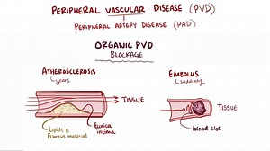 Video: Peripheral artery disease - Video Explanation! | Osmosis | Osmosis