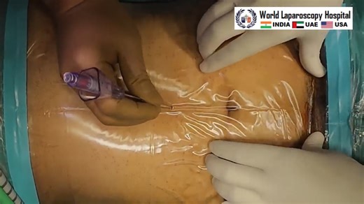 Laparoscopic Dermoid Cyst Removal Surgery | Minimally Invasive Ovarian Cystectomy at WLH