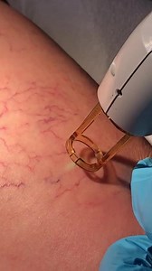 Laser Ablation of Leg Veins