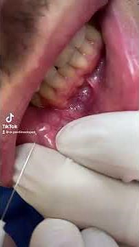 ¿Qué es ese BULTO en el labio?👄 Mucocele tratamiento #shorts