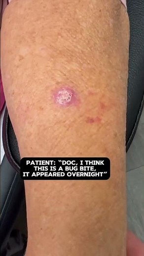 Squamous cell carcinoma (SCC) are a very common skin cancer