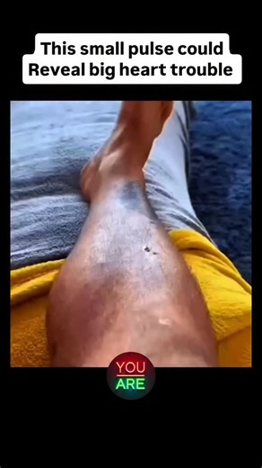 This small pulse could reveal BIG heart trouble. Most people never think twice about the pulse on top of their foot — but your body’s signals often whisper before they scream. A strong dorsalis pedis pulse might look like good circulation, yet it can sometimes mean your heart is under pressure. Doctors say your feet can reveal hidden cardiovascular problems long before chest pain ever shows up. When the veins swell or the pulse feels exaggerated, your body might be telling you something much dee