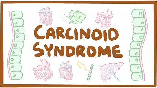 Carcinoid syndrome: Video, Causes, & Meaning | Osmosis