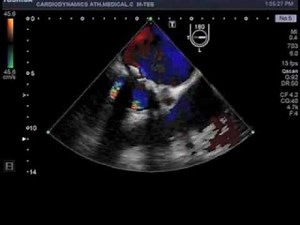 Paravalvular leak in mitral valve prosthesis