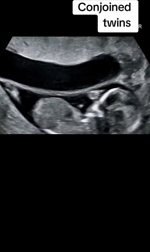 Understanding Conjoined Twins on Ultrasound