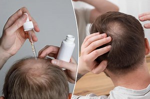 Experimental serum could reverse baldness within 20 days — here’s how it works