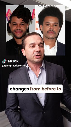 The Weeknd Before & After Plastic Surgery Transformation Revealed